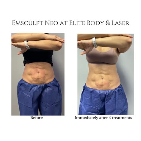 Emsculpt Neo Next Generation Body Contouring Elite Body And Laser