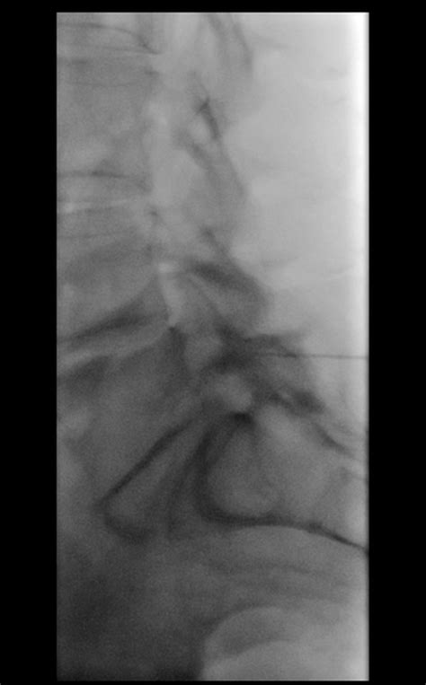 L S Interlaminar Epidural Steroid Injection Fluoroscopic Guided