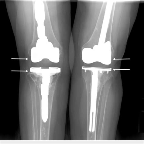 Preoperative X Ray Showing Hardware Prior To Bilateral Revision Total