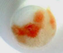 Hemoptysis Sputum