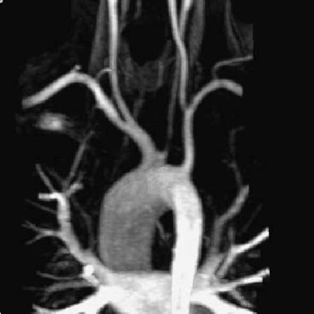 Maximum Intensity Projection Magnetic Resonance Angiogram Subsequent To