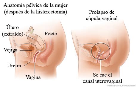 Prolapso de cúpula vaginal Cigna