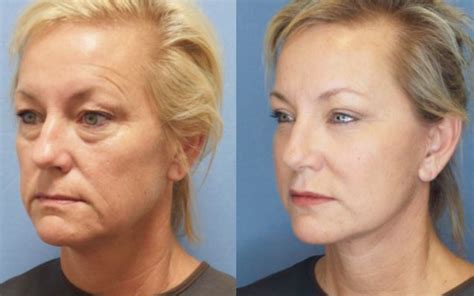 Neck Contour Surgery Guerrero Plastic Surgery