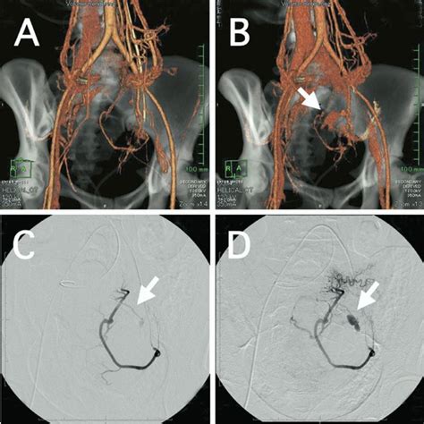 Case 9 Showing Postoperative Hemorrhage After Laparoscopic Assisted