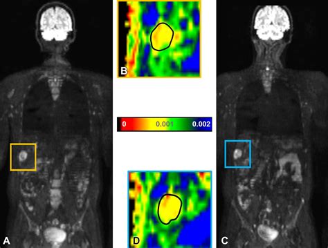 Early Whole Body Diffusion Weighted Mri Helps Predict Long Term Outcome