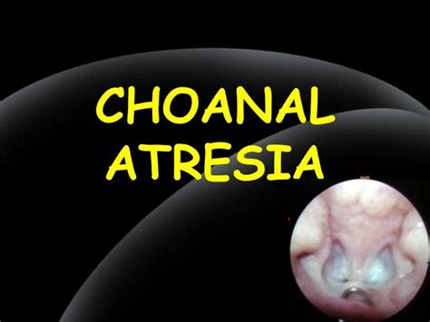 Choanal atresia in children