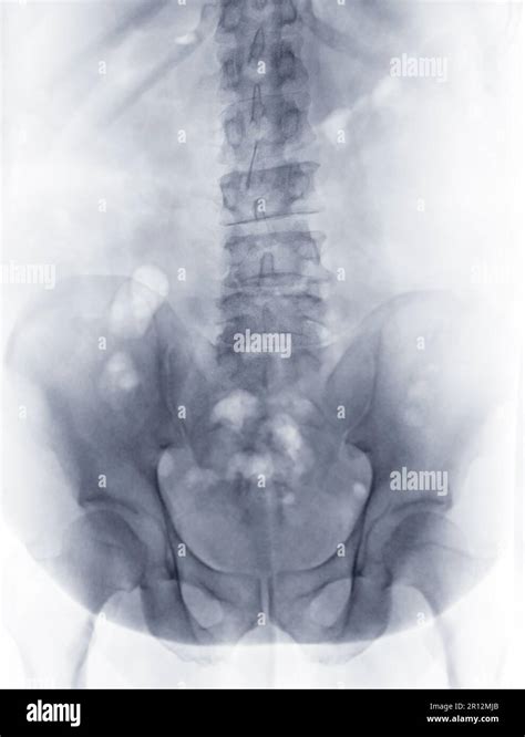 X Ray Image Of Lumbar Spine Or L S Spine Lateral View For Diagnosis