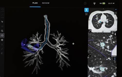 How a robot can help diagnose lung cancer sooner