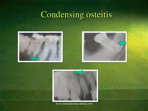 Periapical Radiopacities Dental Implant Courses