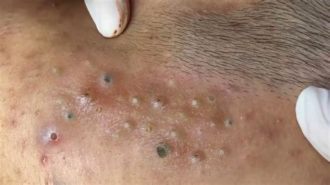 Ystic Acne Extraction This Week Blackheads Removal Blackhead