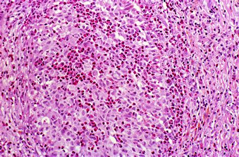 Eosinophilic Granuloma Pathology Orthobullets