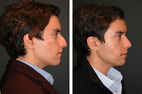 Male Rhinoplasty | Best Male Rhinoplasty Results