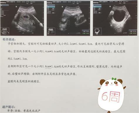 孕期到底做几次b超 7张真实的检查单 怀孕到分娩全过程都齐了先兆流产胎儿b超新浪新闻