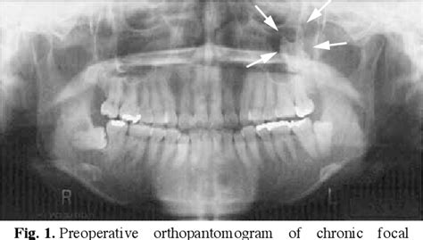 Figure 1 From Chronic Focal Sclerosing Osteomyelitis Accompanied With Bony Mass Protrusion Into