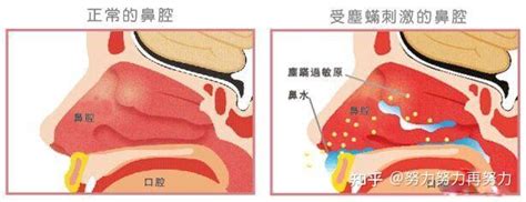 过敏性鼻炎和慢性鼻炎的区别？ 知乎