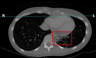 My Life With a Pulmonary Sequestration: My CT Scan