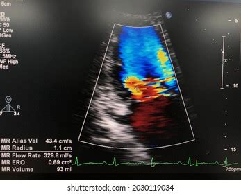 Transthoracic Echocardiogram Tte Shown Measurement Severity Stock Photo 2030119034 | Shutterstock