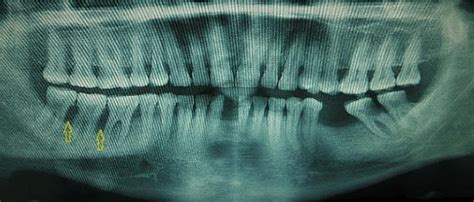 Cropped Panoramic Radiograph Showing Extent Of Bone Loss Yellow