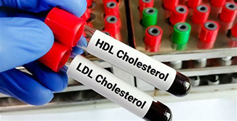 The Link Between High Good Cholesterol Levels And Dementia Risk New