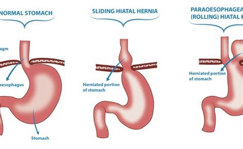 Hernia Symptoms Abdomen Hiatal Hernia Types Of Hernia Treatment Hernia