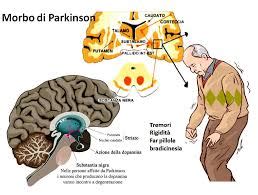 Morbo Di Parkinson Centro Anziani Montalto