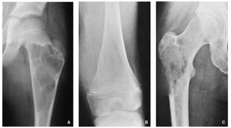 Diagnosis Of Bone Tumors Radiologic And Pathologic Approach