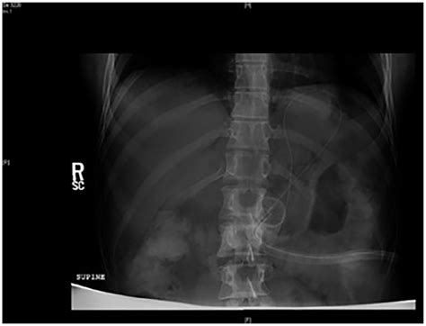 Percutaneous Endoscopic Jejunostomy Tube Placement For Treatment Of