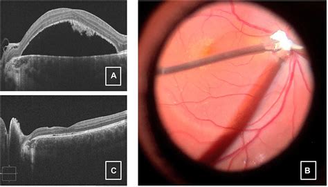 Surgical Options For Optic Disc Pit Maculopathy Perspectives And Cont Opth