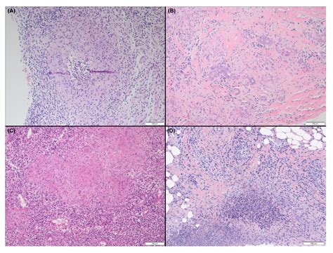 Different Histological Patterns Of Granulomatous Mastitis A Download Scientific Diagram