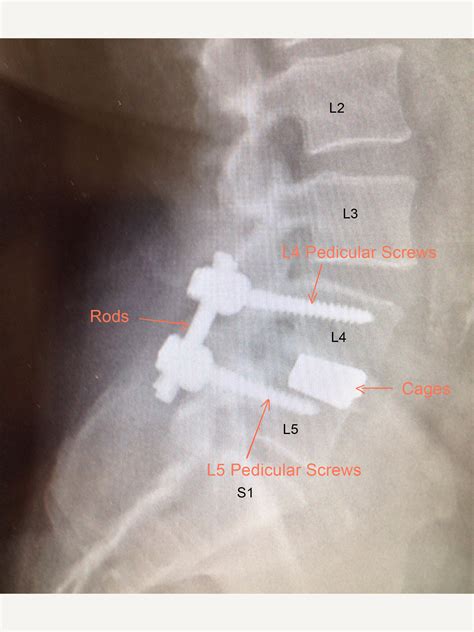 Lumbar Posterior Instrumented Fusion Spines Dorset