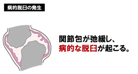 関節リウマチについて正しいのはどれか【第53回理学療法士国家試験am87】 — 理学療法士国家試験対策ptes