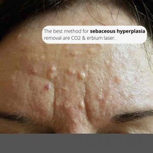 Best Sebaceous Hyperplasia Treatments In Australia