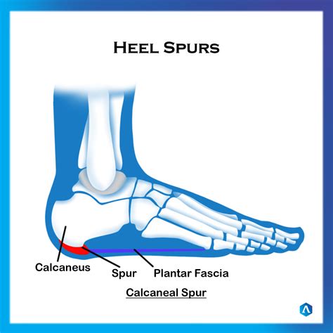 Calcaneal Spur