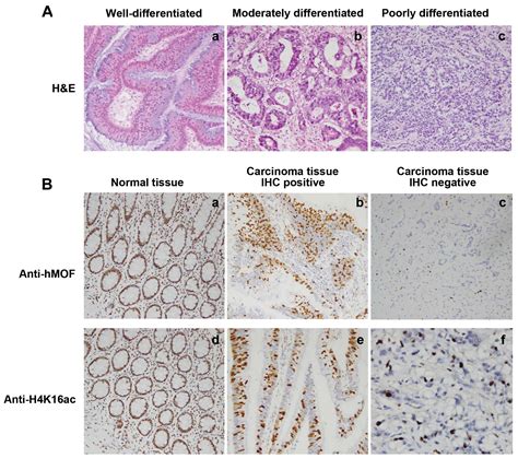 Correlation Of Low Expression Of HMOF With Clinicopathological Features