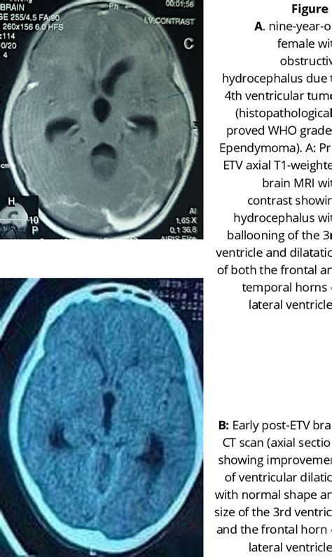 Figure 1 From Endoscopic Third Ventriculostomy For Obstructive Hydrocephalus Semantic Scholar