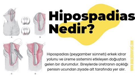 Hipospadias Nedir Peygamber S Nneti Ameliyat