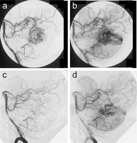 Lateral Views Of Pre Embolization Early Arterial Phase A And Late