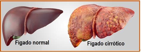 Cirrose Hep Tica A Fase Irrevers Vel Da Les O Hep Tica Dra Keilla