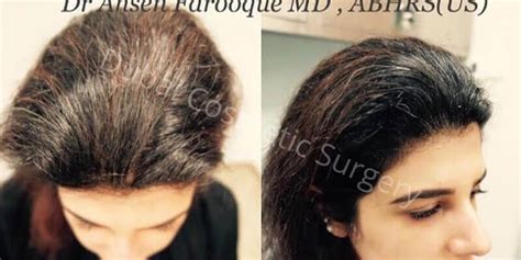 Female Hair Transplant In Dubai Dubai Cosmetic Surgery