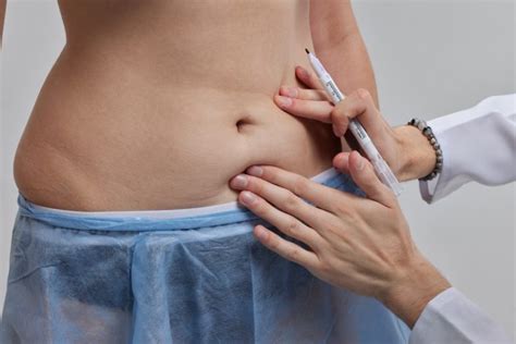 Abdominoplastie Est Ce Rembours Par La S Curit Sociale