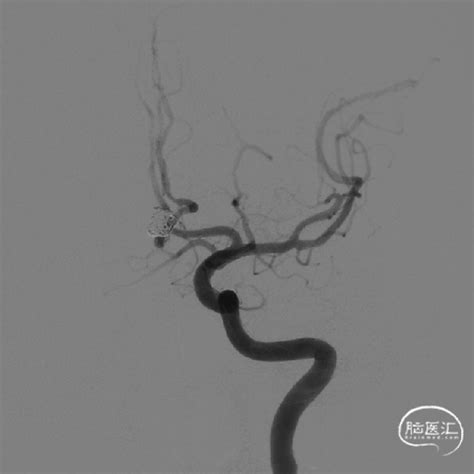 Atlas病例集丨刘赫：atlas支架辅助栓塞前交通宽颈动脉瘤——附体外再装载操作方法详解 脑医汇 神外资讯 神介资讯