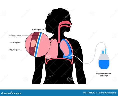 Tunneled pleural catheter stock vector. Illustration of drain - 276844013