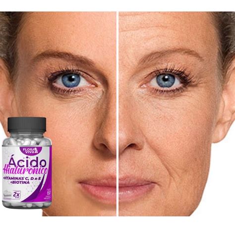 Acido Para Espinha No Rosto - acido para pele tira espinhas, tira manchas do rosto, ACIDO HIAROLONICO ...