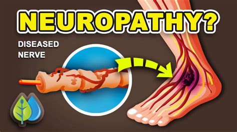 Beware! 7 Neuropathy Causing Medications You Need To Know