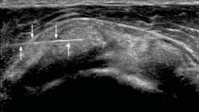 Ultrasound Guided Barbotage Of Calcific Tendinitis Of The Rotator Cuff