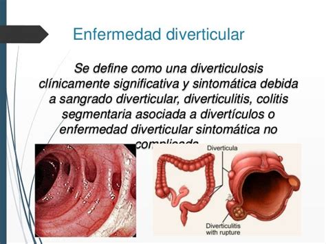 Colon Y Enfermedad Diverticular