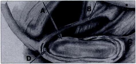 Buford Complex Diagram Shows Anatomic Variation Of Absent Anterior