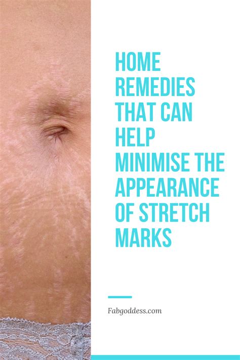 Home Remedies To Get Rid Of Stretch Marks Stretch Marks Home