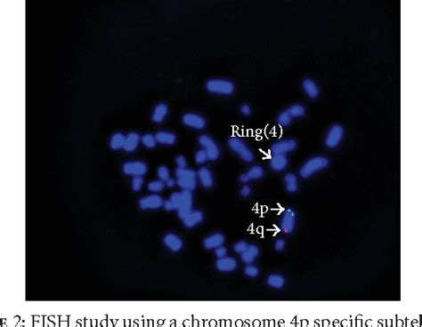 Figure 1 From Prenatal Diagnosis Of 4p And 4q Subtelomeric