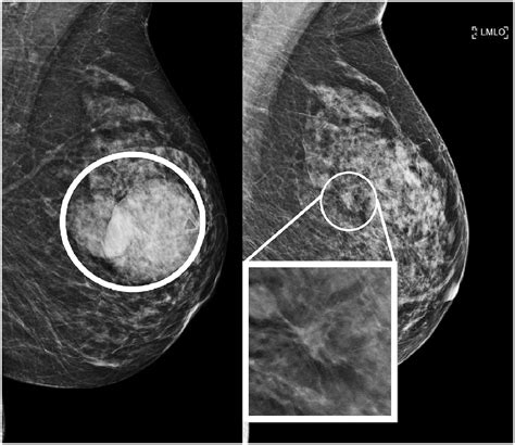 Mammogram Showing Cyst